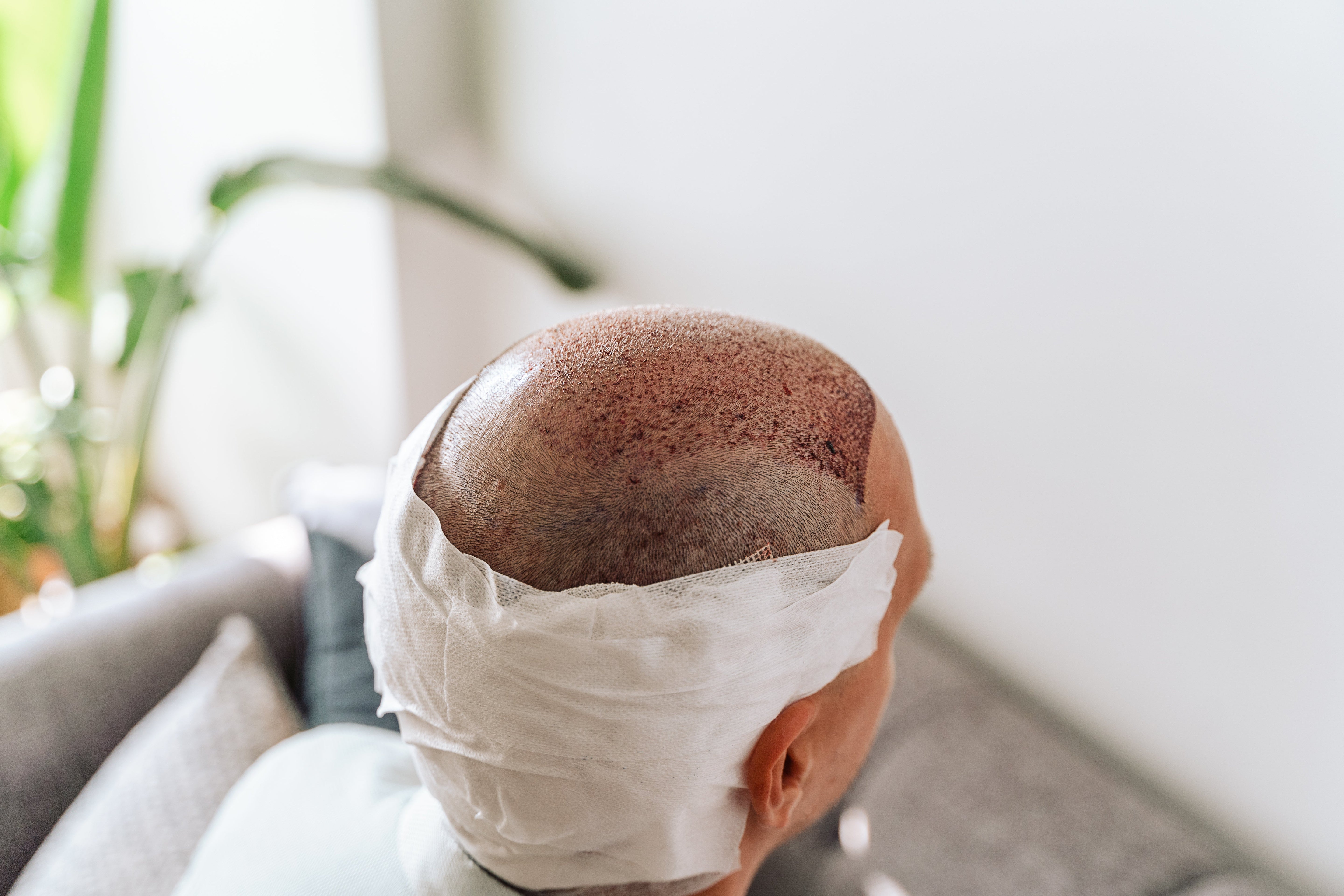Hair Transplant Considerations and Cost: A Detailed Breakdown