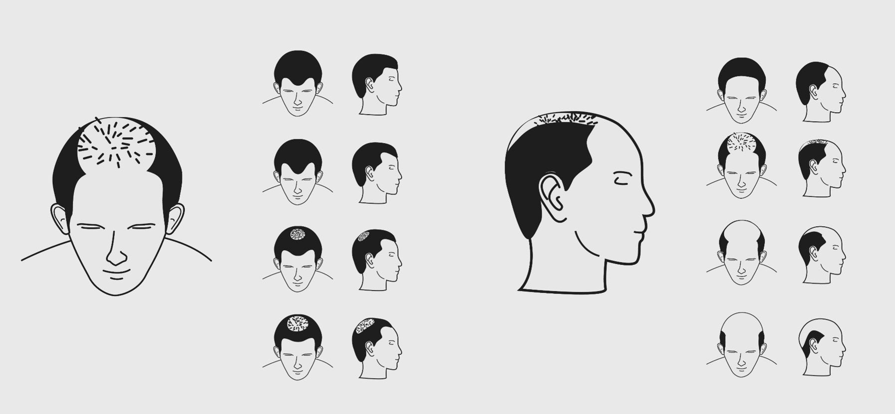 A Closer Look at Androgenic Alopecia (Male Pattern Baldness): From Early Signs to Balding Estimates