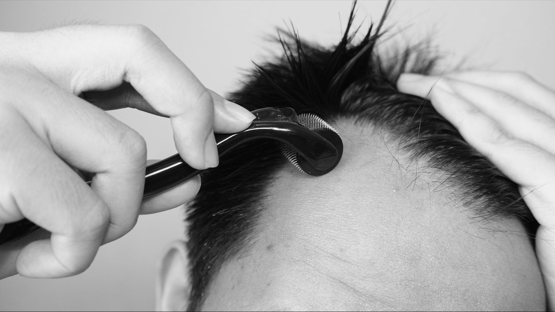 Micro-Needling Therapy For Hair Growth